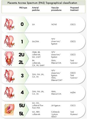 Advantages of individualizing the placenta accreta spectrum management